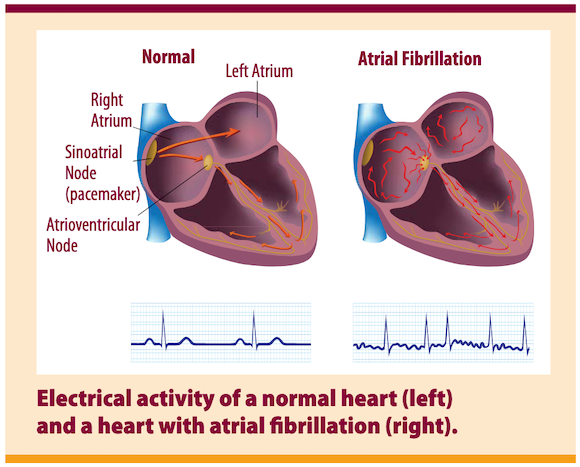 AFib in CDC