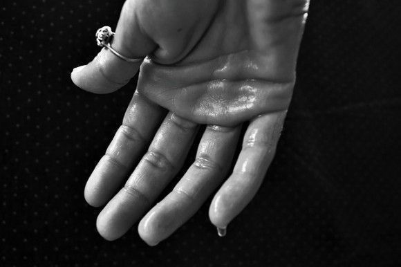 https://pixabay.com/en/hand-hyperhidrosis-sweating-1502242/